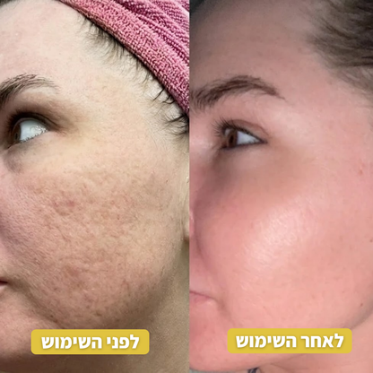 Infuse™ פתרון האנטי-אייג'ינג הביתי