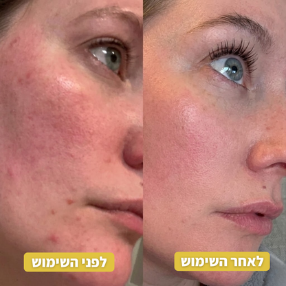 Infuse™ פתרון האנטי-אייג'ינג הביתי