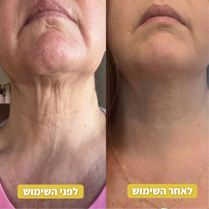 Infuse™ פתרון האנטי-אייג'ינג הביתי